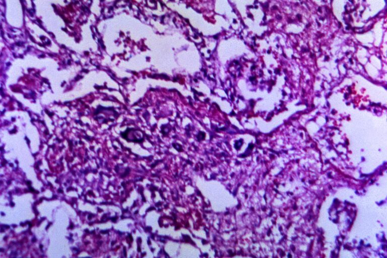 A 125X photomicrograph magnification of a hematoxylin and eosin (H&E)–stained lung tissue specimen, revealed the presence of cytoarchitectural changes indicative of a blastomycosis fungal infection. Original image sourced from US Government department: Public Health Image Library, Centers for Disease Control and Prevention. Under US law this image is copyright free, please credit the government department whenever you can”.